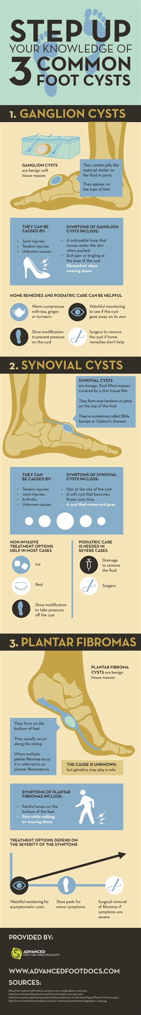 Foot Cyst Infographic Cysts Infographic Health Bunion Treatment