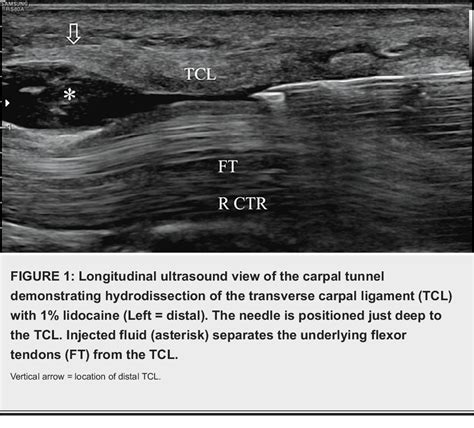 Figure 1 From Office Based Carpal Tunnel Release Using Ultrasound