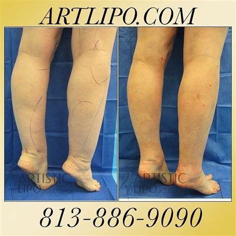 Pin On Cankles Ankles Calves The Best Liposuction Expert Dr Thomas Su