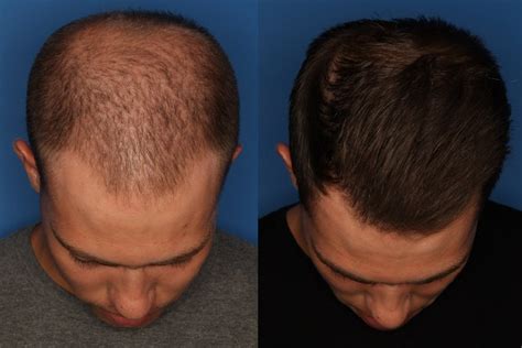 Patient 24560991 Prp Hair Loss Before And After Photos Laser Cliniqúe
