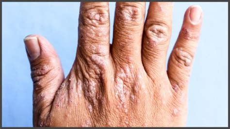 Shingles On Hands Pictures Shingles Expert