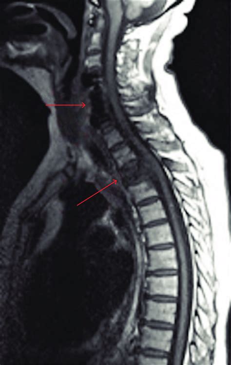 Spinal Mri Demonstrating T3 Vertebral Lesion As Well As Cervical