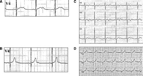 Exercise Training Induced Repolarization Abnormalities Masquerading As