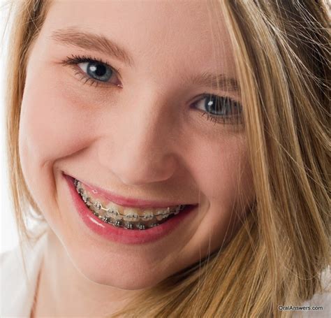 The american association of orthodontists claims that treatment usually starts when the patient is between 9 and 14. 60 Photos of Teenagers with Braces | Oral Answers
