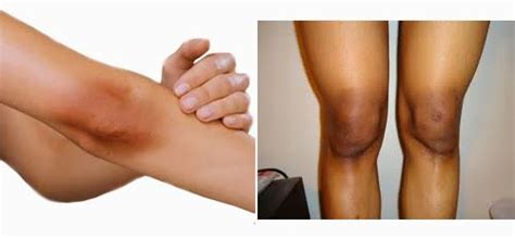 12 Simple Ways To Get Rid Of Black Kneeselbow Daily Health Tips By