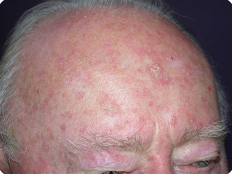 What Is Actinic Keratosis Treatment Herbal Care Products Blog