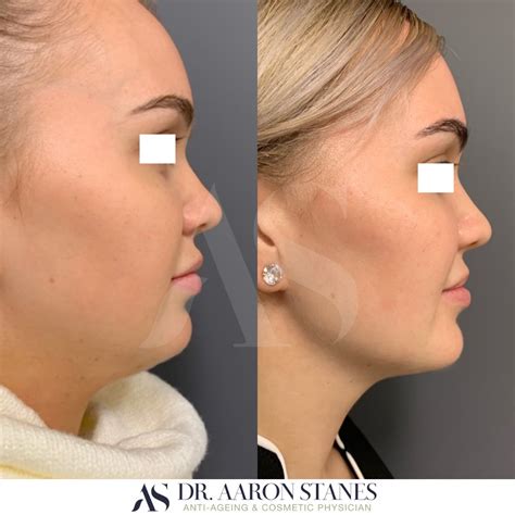 Chin Sculpting Example 3 Dr Aaron Stanes Anti Ageing And Cosmetic
