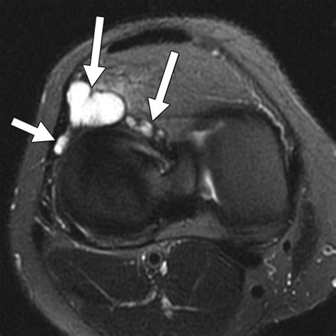 Association Of Parameniscal Cysts With Underlying Meniscal Tears As Identified On Mri And