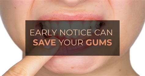 6 Early Symptoms Of Gum Disease Marham
