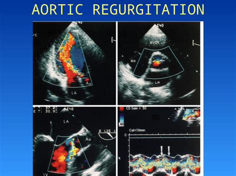 Ppt Aortic Regurgitation Aortic Regurgitation Etiology Leaflets