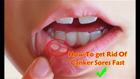 How To Get Rid Of Canker Sores Fast And Permanently Party 2 Youtube