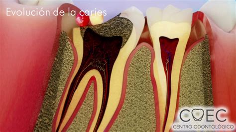 Evolucion Caries Endodoncia Cl Nica Dental Roca Santiago The Best