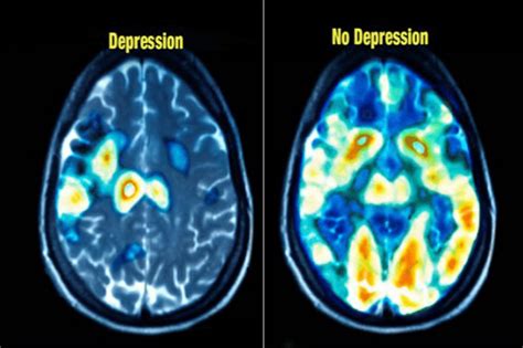 An Example Of Depression And Normal Brain By Mri Image Is From