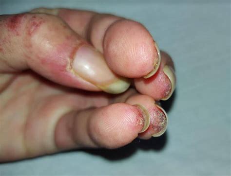 Dermdx Diffuse Rash Affecting Fingertips Clinical Advisor
