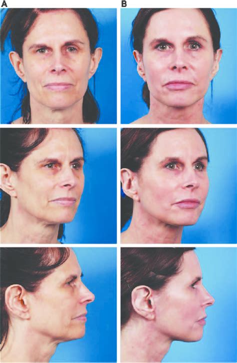This 60 Year Old Woman Underwent A Deep Plane Face Lift Submental