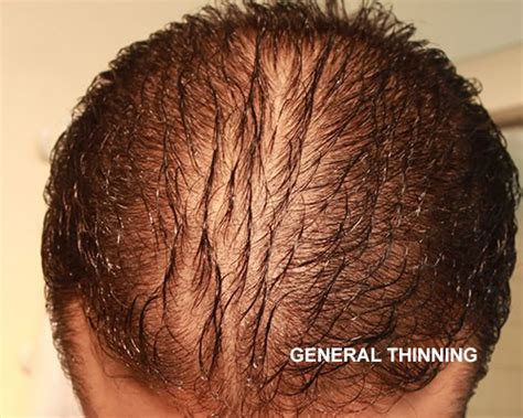 Celiac Disease Hair Loss Reversible Quotes Viral Update