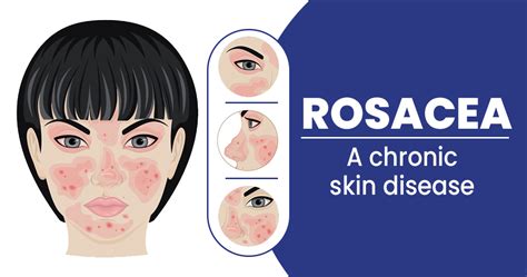 How To Treat Rosacea Causes Symptoms Types Skinkraft