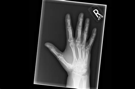 Ortho Dx Severe Unilateral Thumb Pain Clinical Advisor