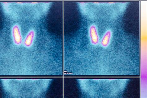 Détecter des métastases osseuses en cas de cancer ( sein, prostate, poumon, etc. Scintigraphie : définition et déroulé de l'examen