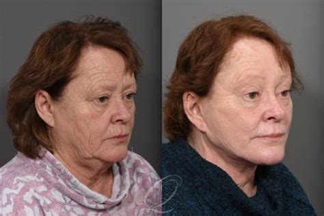 Eyelid Lift Before After Photos Patient 1466 Serving Rochester