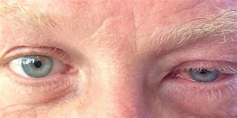 In diesem artikel betrachten wir die virale konjunktivitis näher. The Conjunctiva in Crisis: Ocular Irritation Unmasked