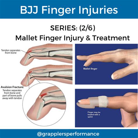 Common Bjj Finger Injuries Part 2 Grapplers Performance
