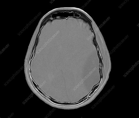 Skull Fracture Ct Scan Stock Image C0552654 Science Photo Library