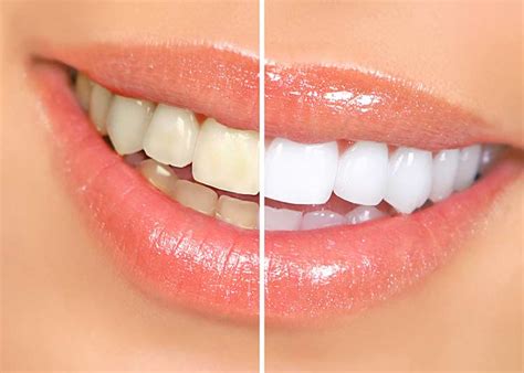 Lipstick color for whiter teeth: 16 DIY Natural Ways to Whiten Teeth
