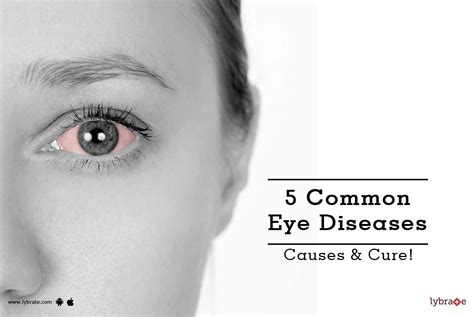 Common Eye Diseases Causes Cure By Dr Ruchi Lybrate