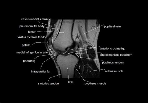 Anatomy of the knee is complex, through the use of magnetic resonance imaging, clinicians can diagnose ligament and meniscal injuries along with identifying cartilage defects, bone fractures and bruises. mri knee anatomy | knee sagittal anatomy | free cross sectional anatomy | | Knee mri, Anatomy ...