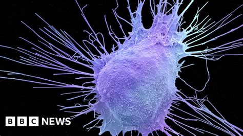 Milestone Prostate Cancer Drug Bbc News