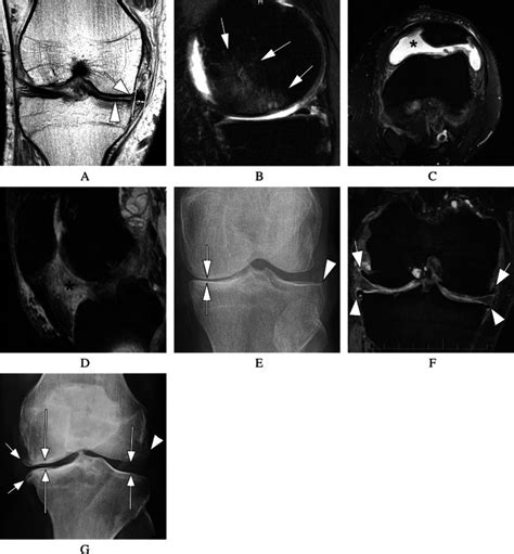 Structural Phenotypes Of Knee Osteoarthritis Potential Clinical And