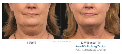 Coolsculpting Before And After Real Patient Photos Vein And Laser Institute