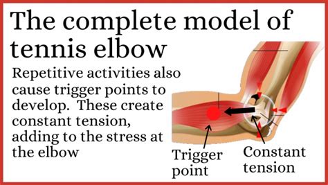 Self Massage And Trigger Point Therapy For Tennis Elbow Dr Graeme