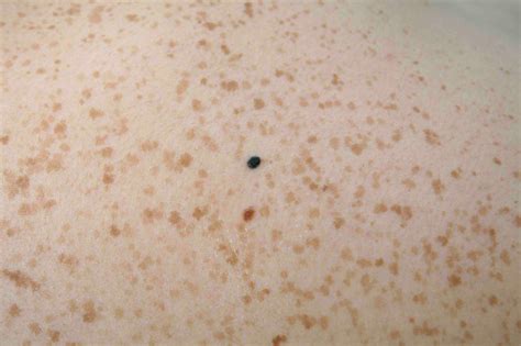 Skin Cancer Freckles Skin Cancer