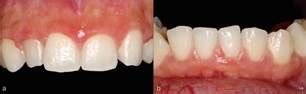 Non Surgical Periodontal Treatment For Drug Influenced Gingival