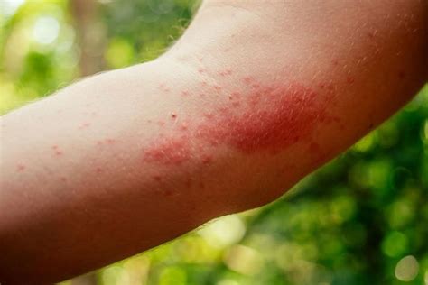 Alergia I Uczulenie Objawy Leczenie Profilaktyka Naturalnie My Xxx