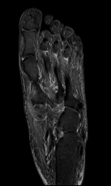 The muscles lie within a flat fascia on the dorsum of the foot (fascia dorsalis pedis) and are innervated by the deep fibular interestingly the dorsal foot muscles generally have no insertion at the little toe. Foot anatomy mri coronal Images