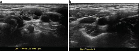 Normal Cervical Lymph Node Appearance And Anatomic Landmarks In Neck