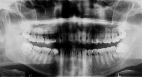 Jaw Fractures Healthscopehealthscope