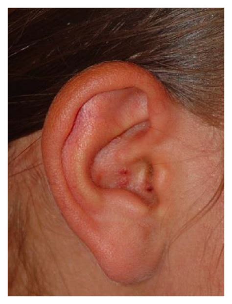 A Pediatric Case Of Ramsay Hunt Syndrome