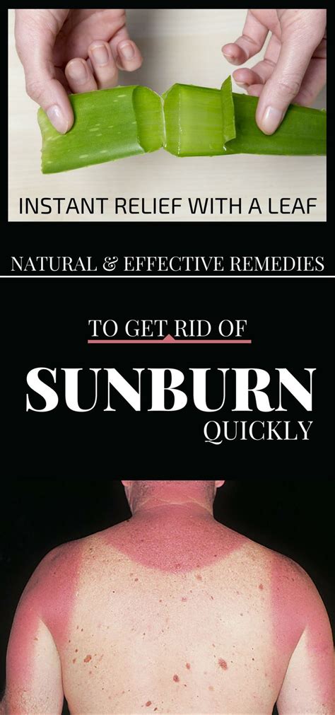 Natural And Effective Remedies To Get Rid Of Sunburn Quickly Get Rid