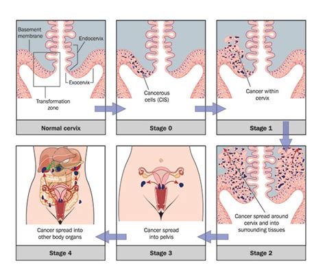 Postmenopausal cervical cancer symptoms common symptoms of vaginal discharge increased vaginal bleeding kidney no function cachexia urinary examination of postmenopausal cervical cancer. BUZUDOG: Cervical cancer symptoms vary extensively at ...