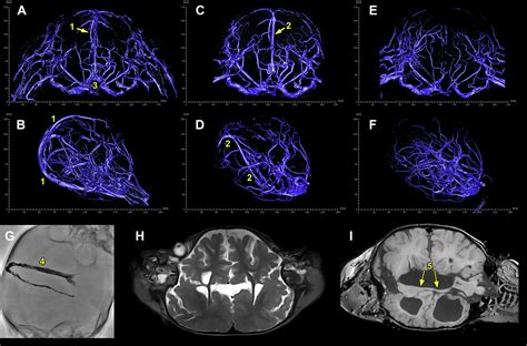 Successful Multistaged Operative Separation Of 3 Year Old Craniopagus