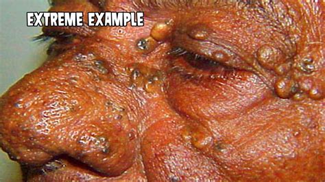 Nodular elastosis with cysts and comedones of favre and racouchot (111200005). Extreme Favre Racouchot Syndrome - YouTube
