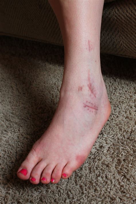 How do we fix a chipped fingernail? Mary Go Round (How to Fix a Broken Ankle): And the winner ...