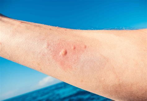 Jellyfish Sting Symptoms What To Do And What To Avoid