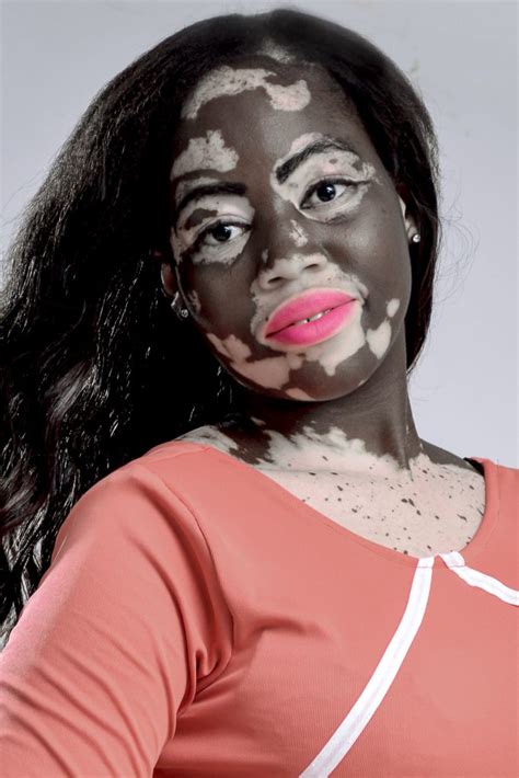 Check spelling or type a new query. » Self-conscious woman with vitiligo turns Nation model ...