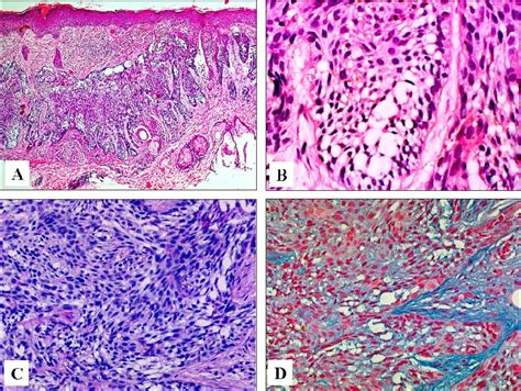 Figure 2 From Clear Cell Basal Cell Carcinoma With Sialomucin