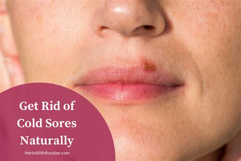 Things like allowing your sores to be exposed to air, talking to your doctor about medications, and using ointments may help speed healing time. Cold Sore Remedies